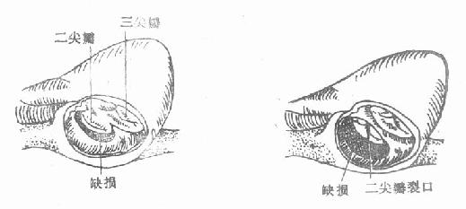 原发孔型房间隔缺损