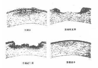 角膜溃疡进行性演变