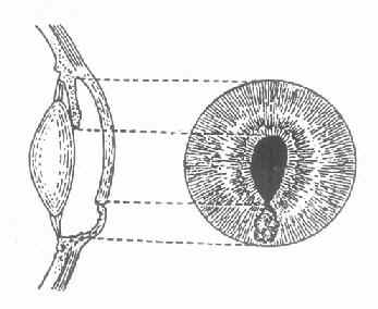 虹膜局部脱出的正面与侧面示意图