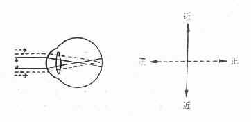 单纯近视散光