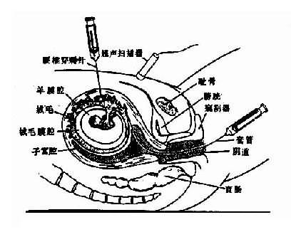 绒毛吸取术示借助超扫描器用能屈的套管或腰椎穿刺针吸取绒毛