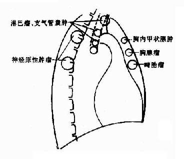 纵隔肿瘤发生部位