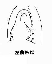 右心室增大