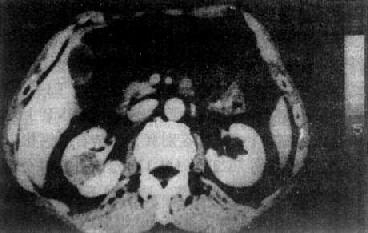 肾癌CT扫描