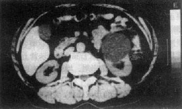 肾囊肿CT扫描