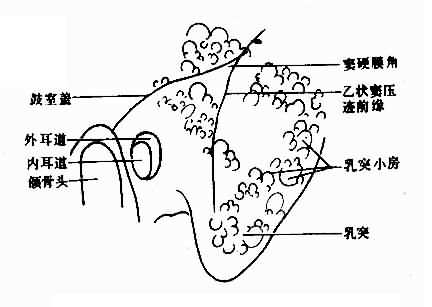 正常中乳突