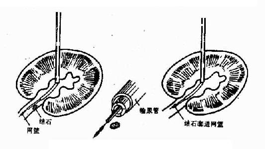 经皮肾盂造口术（套取结石）示意图